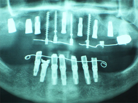 Radiografia con gli impianti inseriti