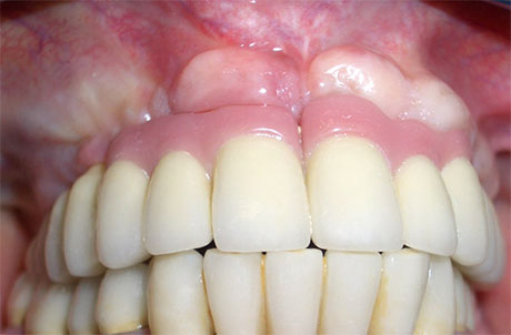 L'impianto con i denti in occlusione
