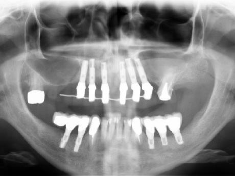 Panoramica dentale dopo l'estrazione degli elementi superiori