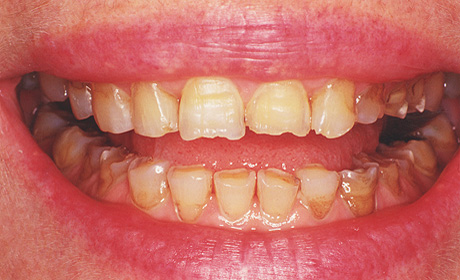 Situazione iniziale: si nota la grave abrasione delle corone 
	  dentali, l'accorciamento dei denti e la colorazione fortemente gialla