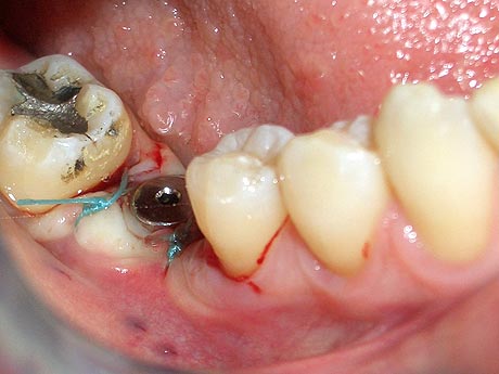Il molare inserito