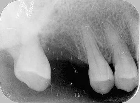 Radiografia della situazione iniziale: il molare mancante
