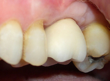 Primo molare superiore sinistro (26): corona finale in porcellana