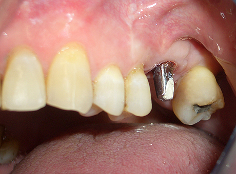 Moncone del 26 - primo molare superiore sinistro - su impianto