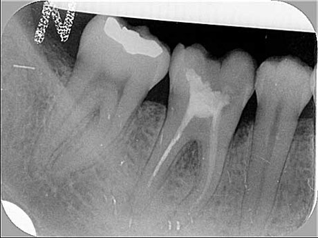 Situazione iniziale: radiografia del molare inferiore destro fratturato (il 46)