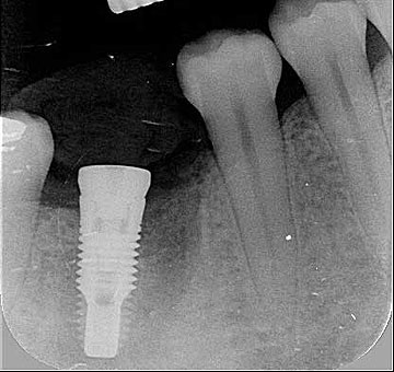 Radiografia dell'impianto al molare inferiore destro (il 46)