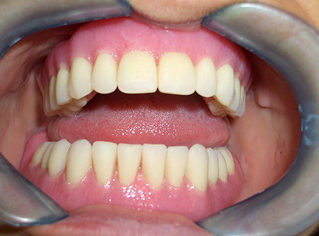 Le protesi finali nella bocca del paziente
