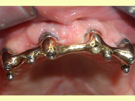 Overdenture: gli attacchi in bocca