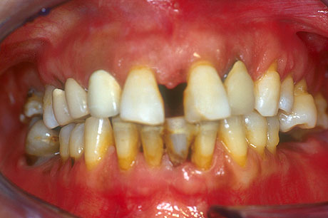 Le arcate dentali iniziali
