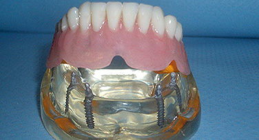 Immagine di una vecchia dentiera stabilizzata - vista inferiore