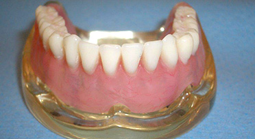 Immagine di una vecchia dentiera stabilizzata - vista superiore