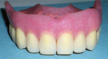 Immagine di una protesi mobile completa superiore o dentiera superiore